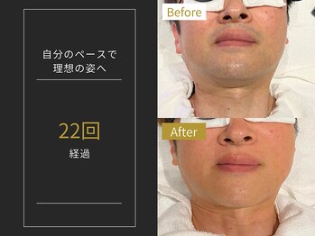 ステイゴールド 新百合ヶ丘(STAY GOLD)/おヒゲ脱毛の経過☆