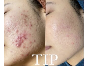 エル(Elle)/【肌改善】ニキビケア/肌質改善