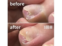 とくしま整体院 藍住院/巻き爪を改善しましょう！！