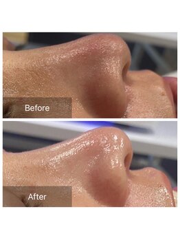 アヴニール 光の森(AVENIR)/毛穴洗浄１回の効果☆