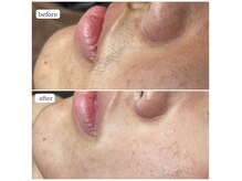 シャルム 広島店(CHARME)/メンズフェイスwax♪