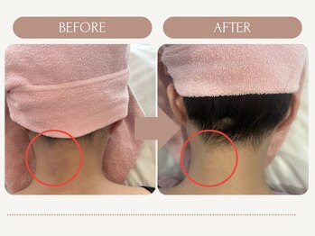 シルク(Cilk)/うなじ脱毛