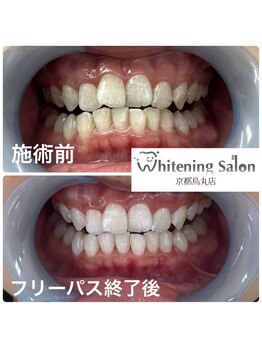 ホワイトニングサロン 京都烏丸店/ホワイトニング施術例　