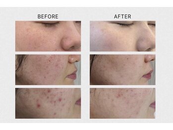 ディオーネ 岡崎店(Dione)/《韓国式ハーブピーリング》