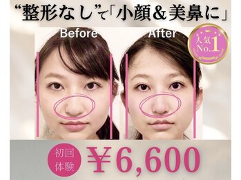 ラプリ 銀座店(Raplit)/隆鼻＋輪郭矯正40分10回
