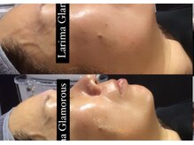 ラリマ グラマラス(Larima Glamorous)/レモンボトルフェイシャル