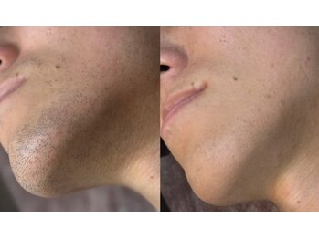 ナーズプラス リベルテ(Naz Plus/Liberte)/メンズ顔脱毛