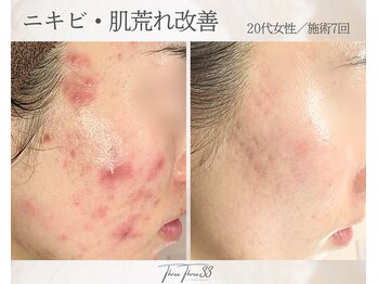 スリースリー 恵比寿(THREE THREE)/ニキビ・肌荒れケア