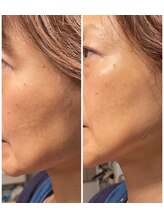 フーレスト アンド フリーリー(Fullest&Freely)/小皺とシミに