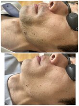 ネイルアンドアイラッシュ シヴァ(Siva)/髭脱毛