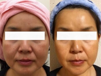 パトラ 難波店/ハーブピーリング★小顔リンクル