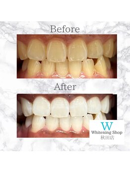 ホワイトニングショップ 秋田店/【before after】 美白
