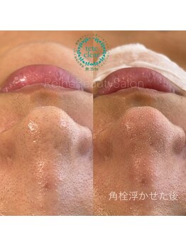 レーヌ(Reine)/毛穴エクストラクション