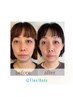 【お顔のたるみ改善】 小顔矯正+ラジオ波+美容整体 集中改善コースお試し90分
