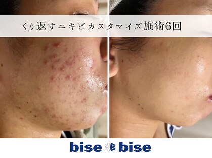 ビズビズ 梅田店(bisebise)の写真