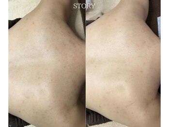 ストーリー 沼津店(STORY)/ハーブピーリング専門店STORY