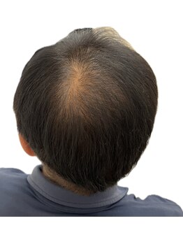 リセル(Recell)/育毛促進ケア