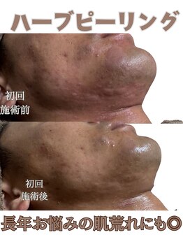 ルクー(RuCoeur.)/陶肌トリートメント肌荒れケア◎