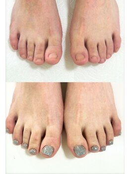 ピノ(pino)の写真/フット深爪矯正年中人気です!【フット深爪矯正+ワンカラー17000円】