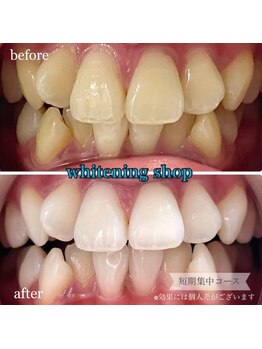 ホワイトニングショップ 桜木町店/歯が不揃いでも綺麗になります！