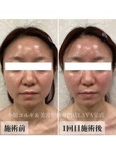 ラバ 名古屋栄店(LAVA)/小顔コルギ【エラ張り】