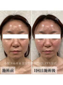 ラバ 名古屋栄店(LAVA)/小顔コルギ【エラ張り】