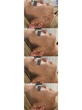 エヌ スタイル(N Style)/ニキビケアハーブピーリング