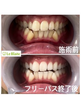 ルブラン 奈良店(Le Blanc)/きちんと白く!モテ度UP!!