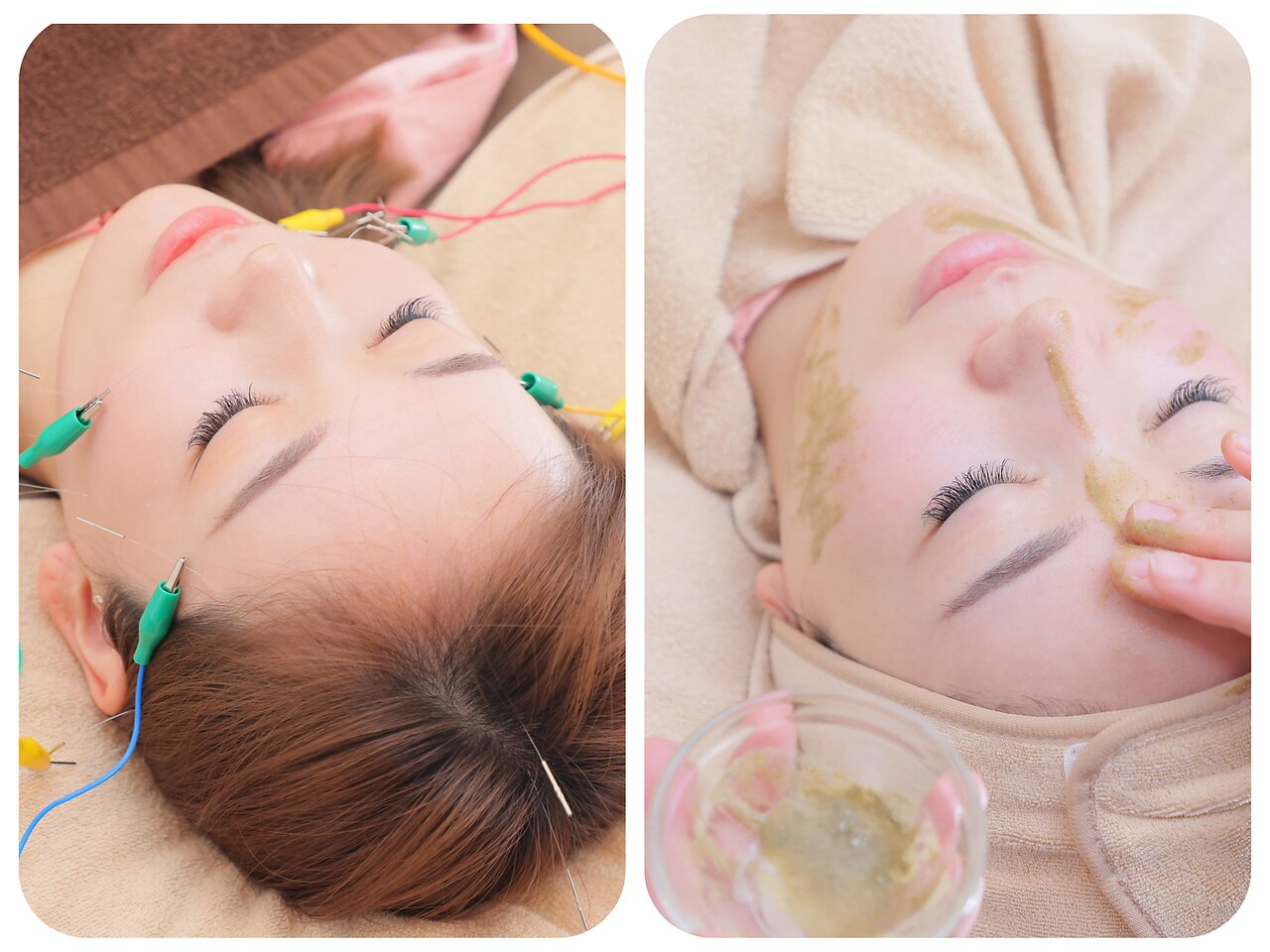 【３月限定！残4名】相性抜群！美容鍼×ハーブピーリング 25960円→9900円