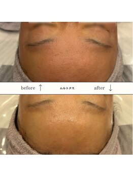 ビーエヌ エステティックアンドスパ(BN Esthetic&Spa)/透明感のある美白へ