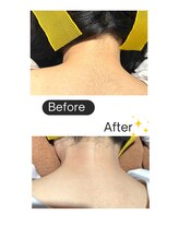 リファイン(Refine)/うなじ脱毛