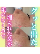 ハニエル(Haniel)/カーボキシービフォーアフター