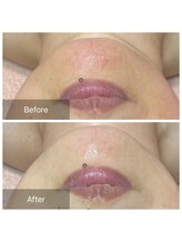 ヒール(heal)/顎に赤み