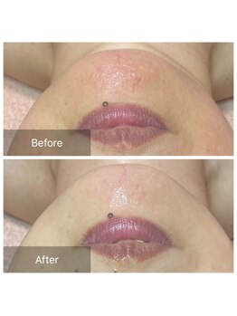 ヒール(heal)/顎に赤み