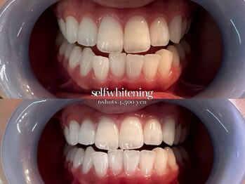 ココロビューティーギャラリー 武蔵小杉(cocorobeauty gallery)/久しぶりのホワイトニング★