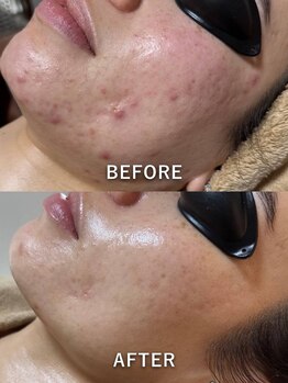 エシャーム(echarme)/肌質改善ケア