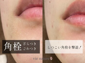ヴィナチュール(vie nature)/しつこい角栓を撃退!