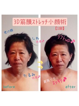 ビューティサロン キヨの部屋(beauty salon)/【３D筋膜ストレッチ小顔術】1回