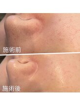 スムース(Smoooth)/毛穴洗浄フェイシャル♪