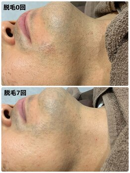 エリーザベル(Elisa Bell)/ヒゲ脱毛途中経過