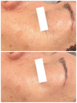 グラサヴォーグ 金沢店/エクスライジング1回施術肌変化