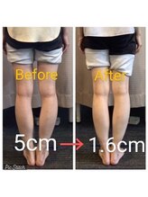 クシロ鍼灸整骨院/【O脚矯正】施術例