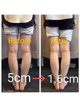 クシロ鍼灸整骨院/【O脚矯正】施術例