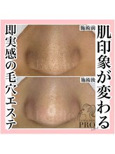 エクラーレ(Eclale)/【毛穴ケア】症例