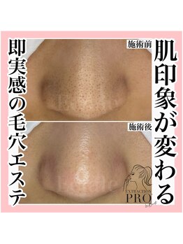 エクラーレ(Eclale)/【毛穴ケア】症例