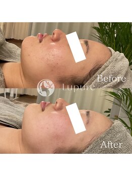 ルプレ(Lupure)/ハーブピーリング12回目