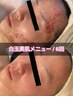 【ニキビにお悩みの方◎】7STEP贅沢メニュー☆¥13000→¥6600