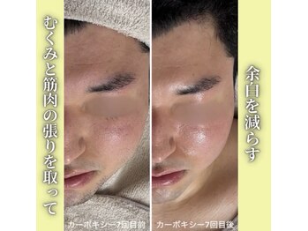 ハニエル(Haniel)/カーボキシー症例