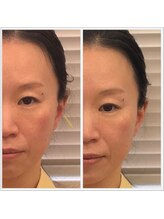 ビューティーパンク 黒田鍼治療院(Beauty Punc)/ほうれい線　VS &nbsp;一本の鍼