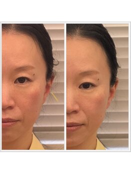 ビューティーパンク 黒田鍼治療院(Beauty Punc)/ほうれい線　VS &nbsp;一本の鍼